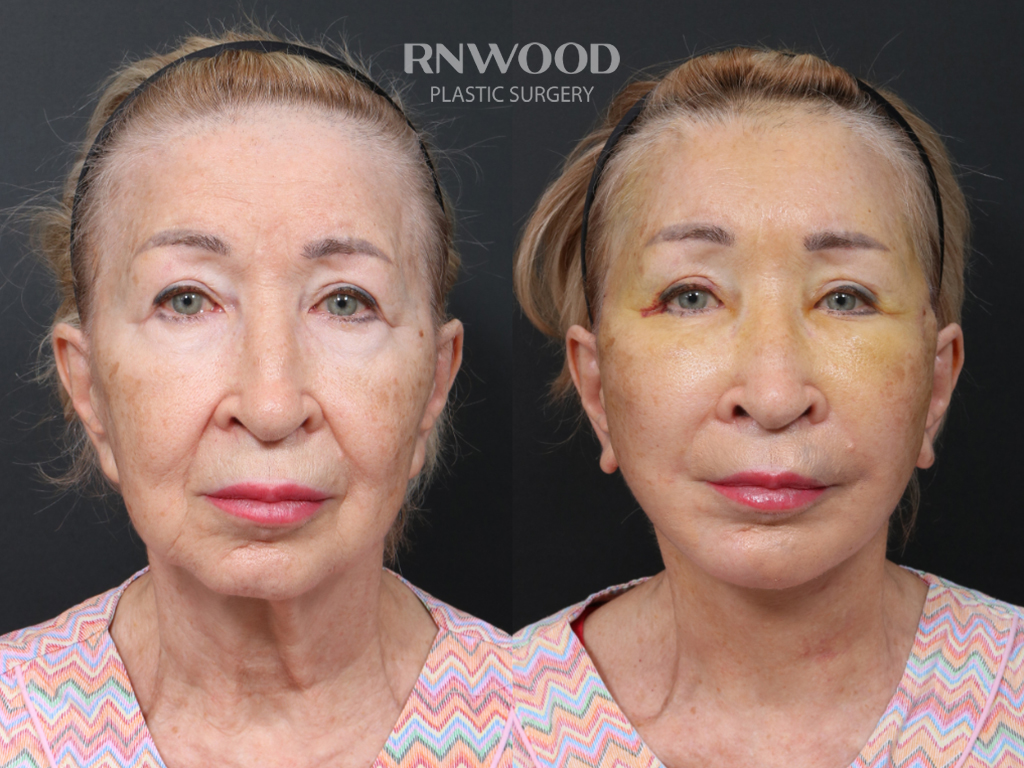 Revision Deep Plane Facelift, Necklift, Submentoplasty, Endoscopic Forehead Lift, Fat Graft