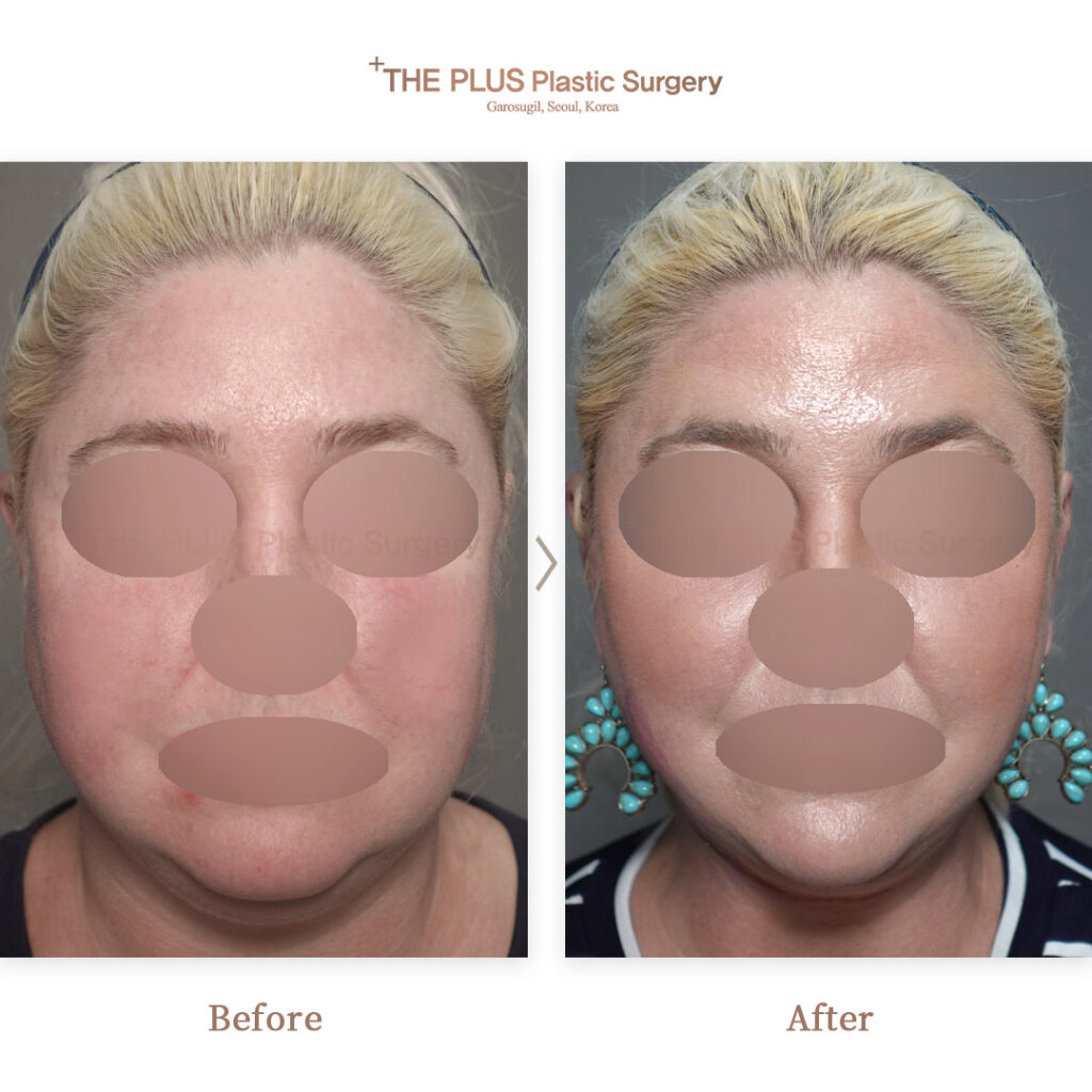 Facelift before and after — THE PLUS PS