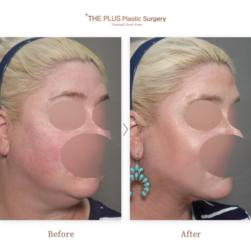 Facelift before and after — THE PLUS PS