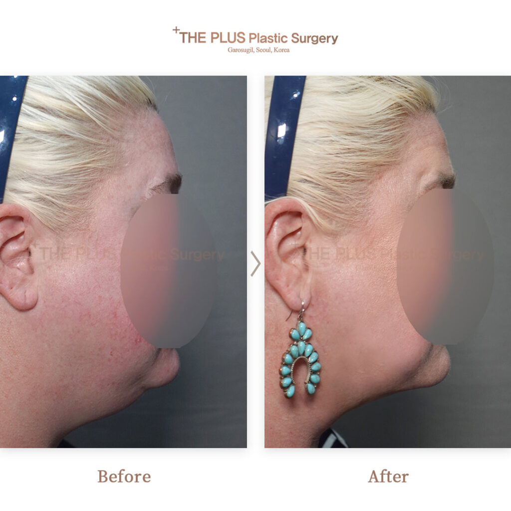 Facelift before and after — THE PLUS PS