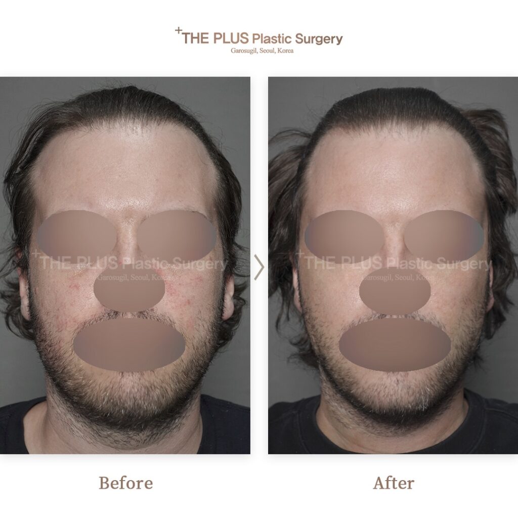 Facelift before and after — THE PLUS PS