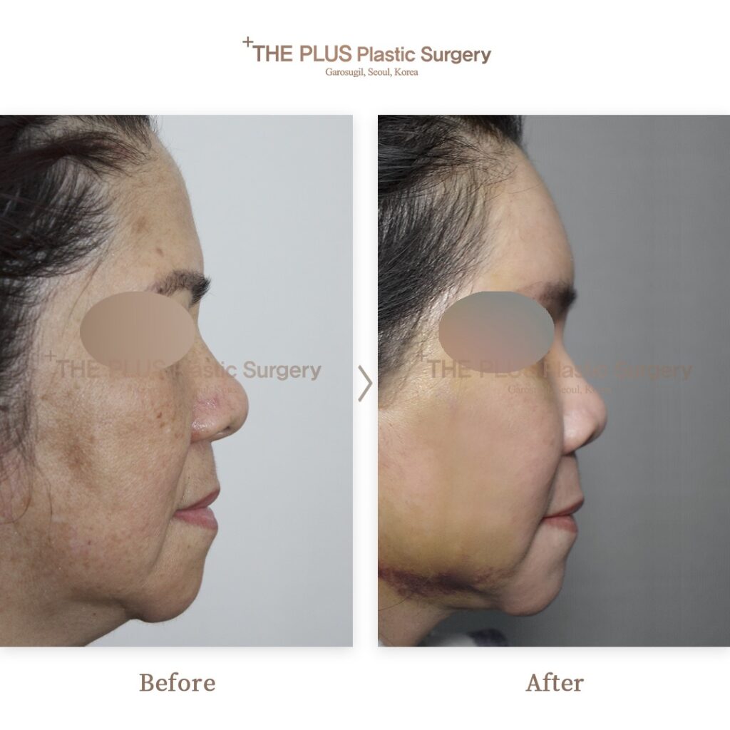Facelift before and after — THE PLUS PS