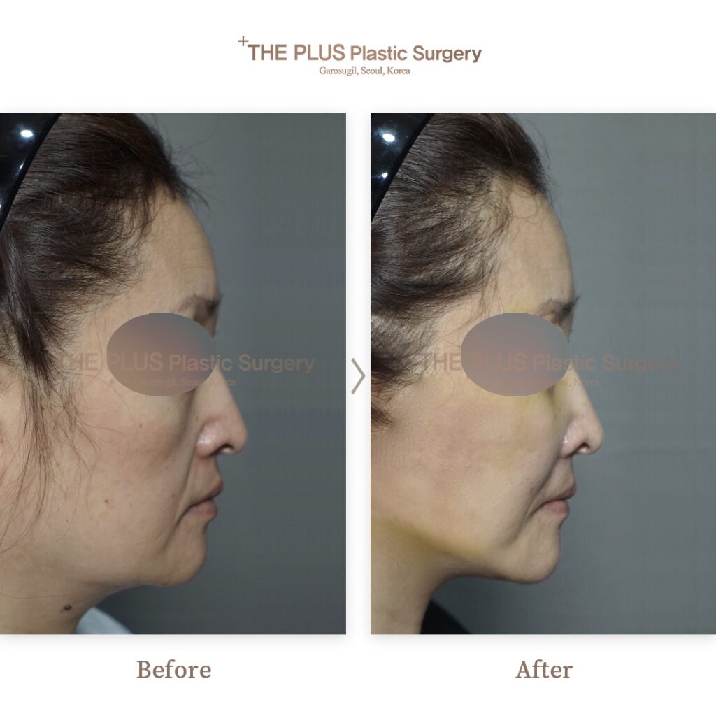 Facelift before and after — THE PLUS PS