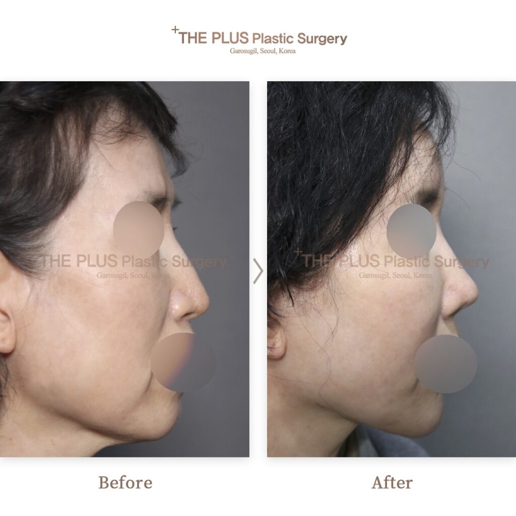 Facelift before and after — THE PLUS PS