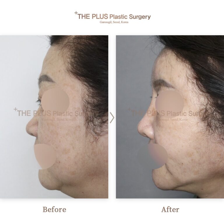 Facelift before and after — THE PLUS PS