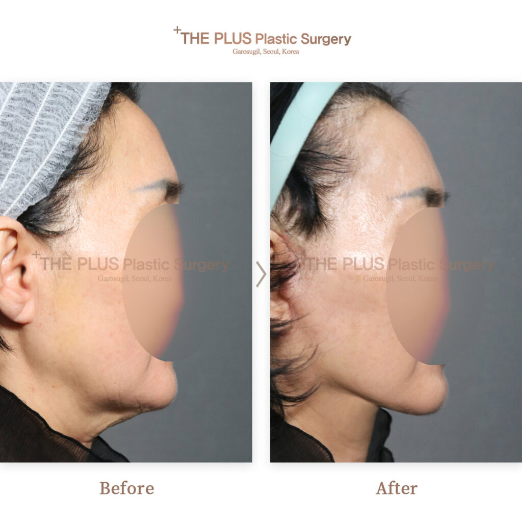 Facelift before and after — THE PLUS PS