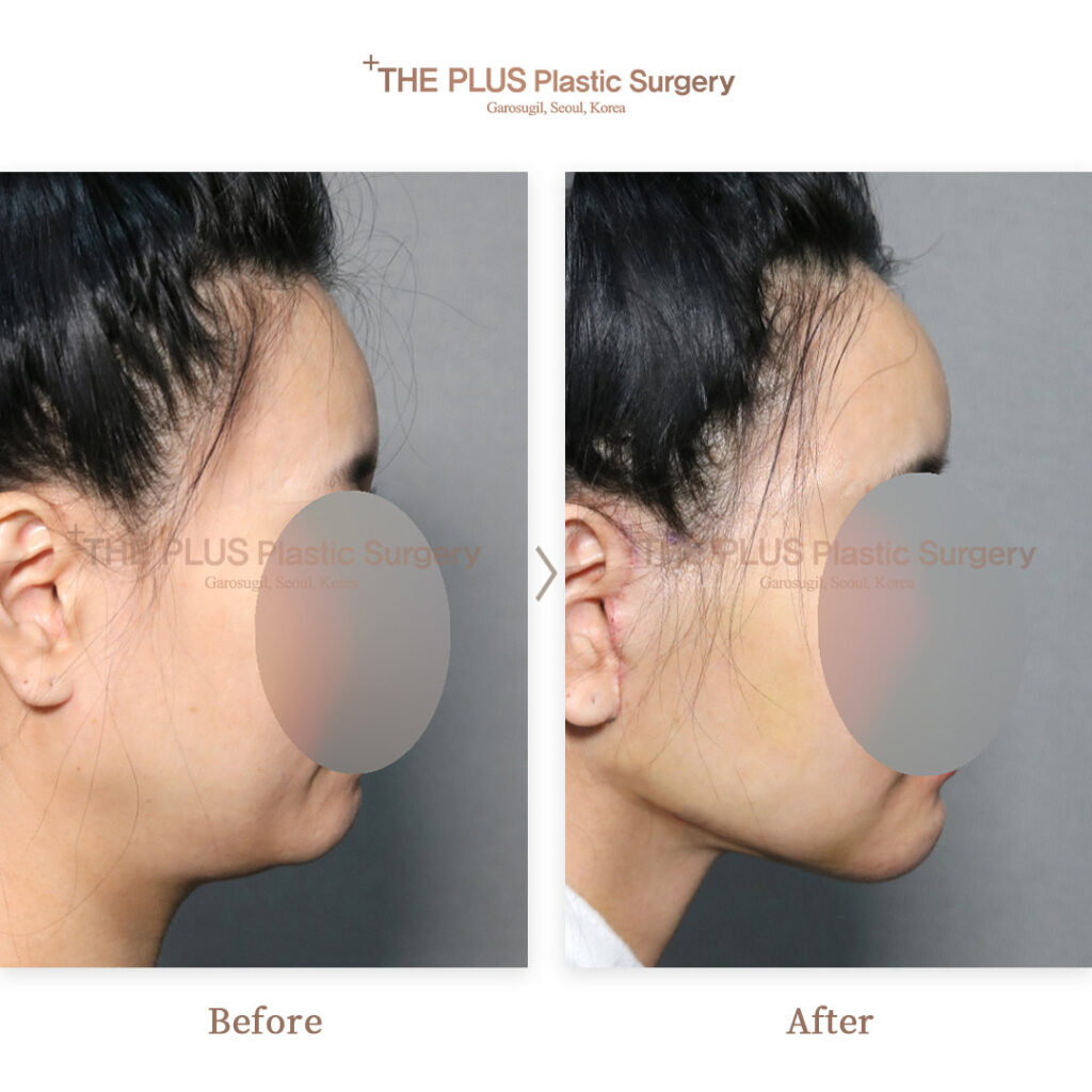 Facelift before and after — THE PLUS PS