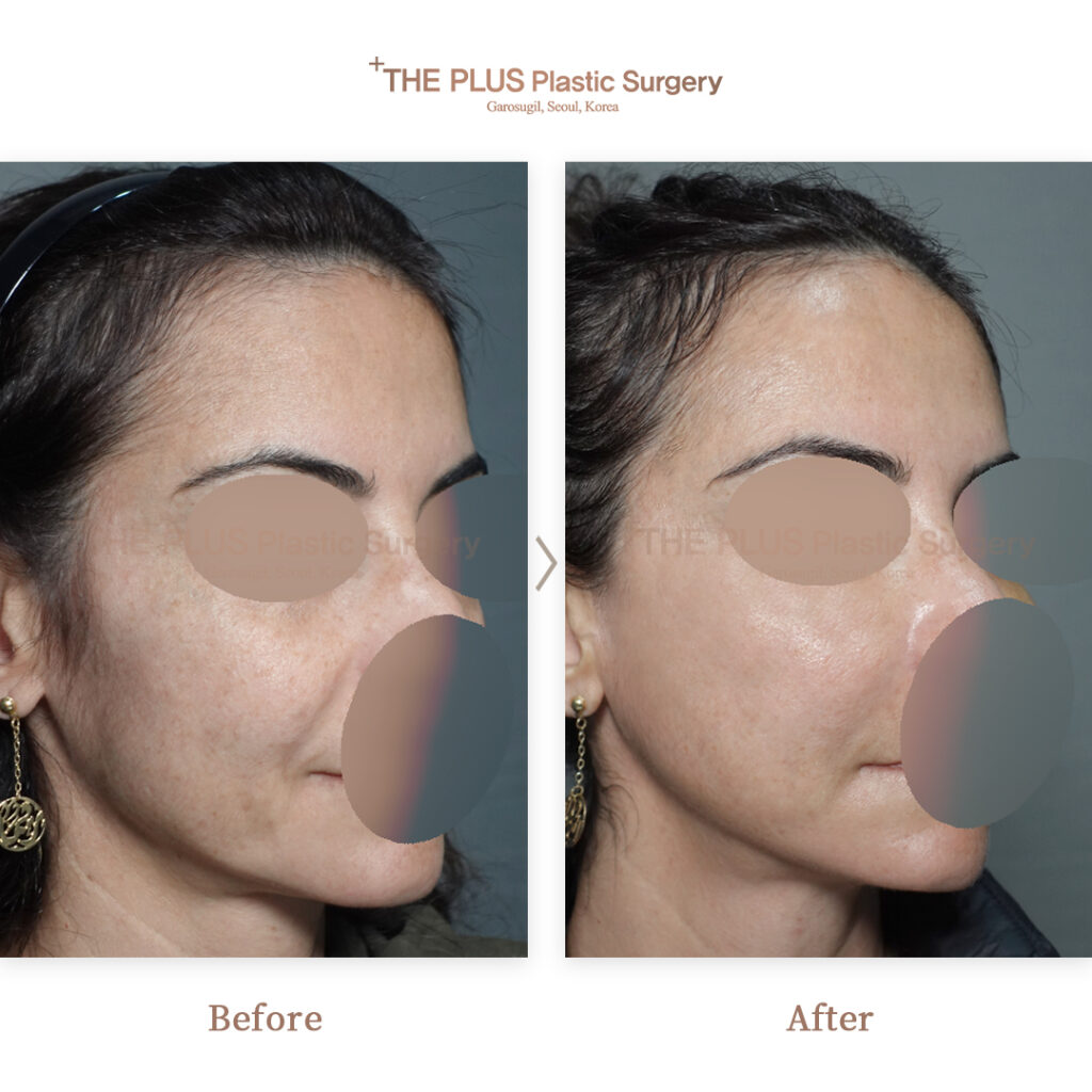 Facelift before and after — THE PLUS PS