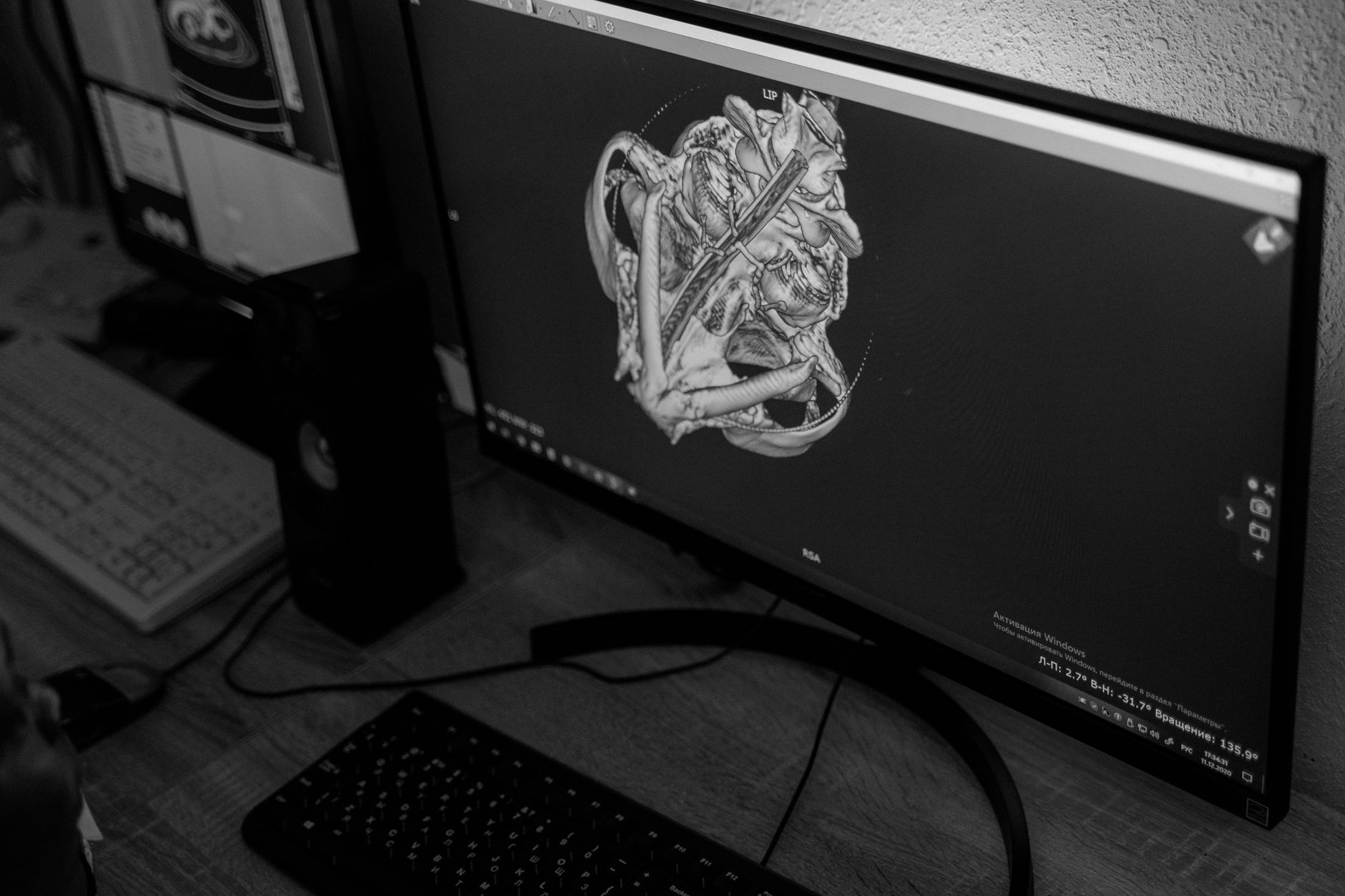 A 3D CT scan model used for surgical planning in jaw correction procedures