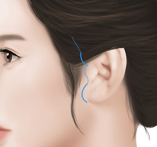 Side-profile illustration showing hidden facelift incision lines along the hairline and in front of the ear.