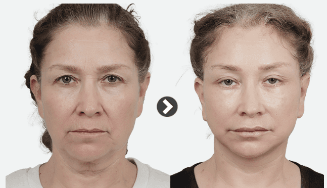 Before-and-after frontal photographs of a woman's face illustrating facial rejuvenation after a facelift.