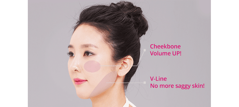 Side-profile diagram of a face highlighting cheekbone volume enhancement and jawline tightening from a volume mini facelift.
