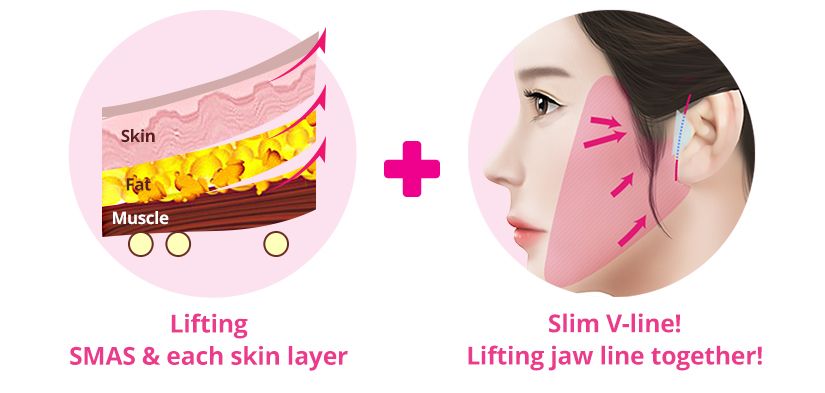 Educational diagram showing the SMAS and skin layers being lifted, alongside a side-profile illustration of jawline lifting for a slimmer V-line.