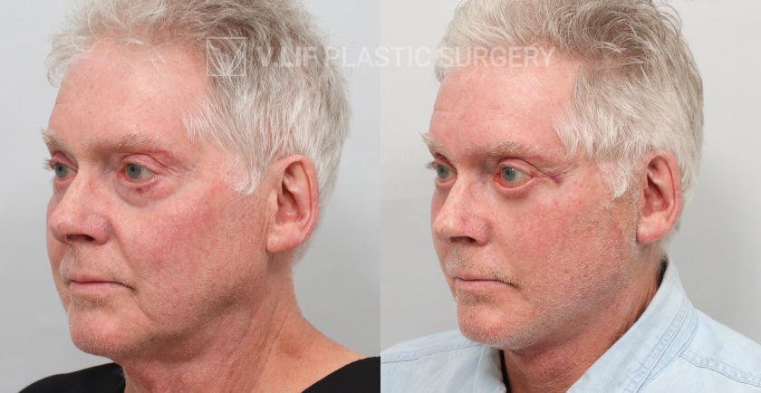Face Neck Lift before and after — Vlif Plastic surgery