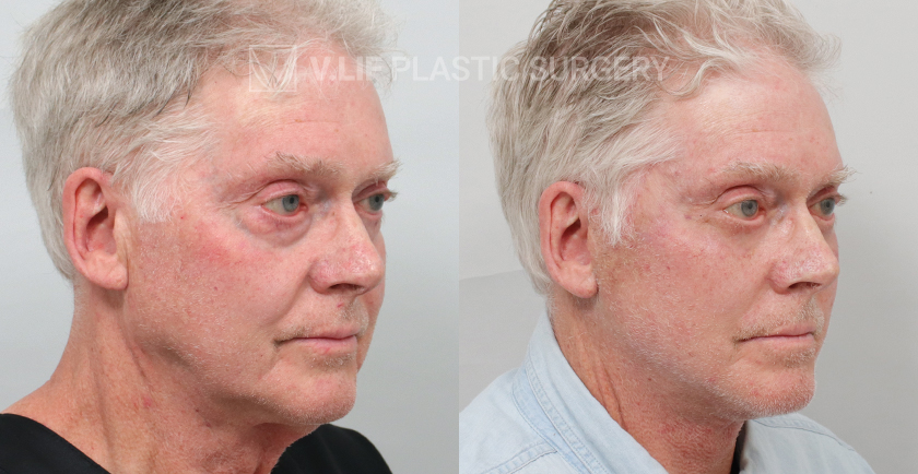 Face Neck Lift before and after — Vlif Plastic surgery
