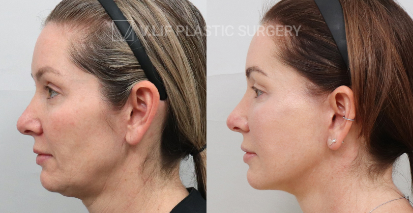 Face Neck Lift (Revision) before and after — Vlif Plastic surgery