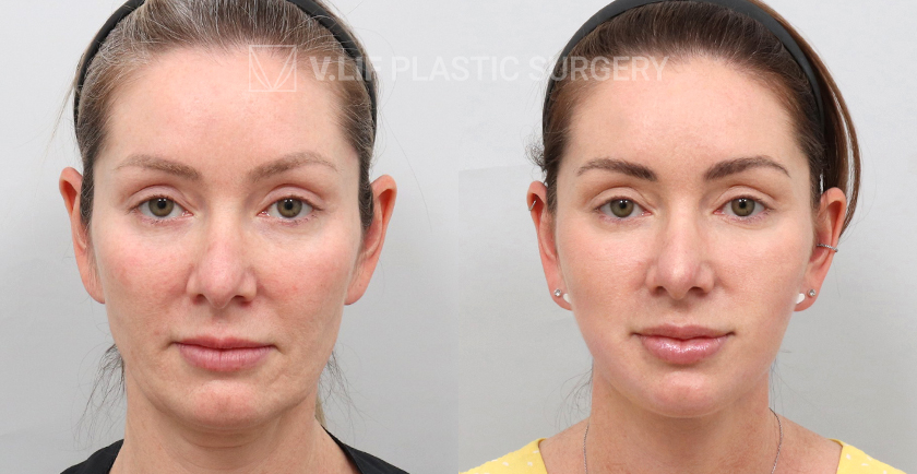 Face Neck Lift (Revision) before and after — Vlif Plastic surgery
