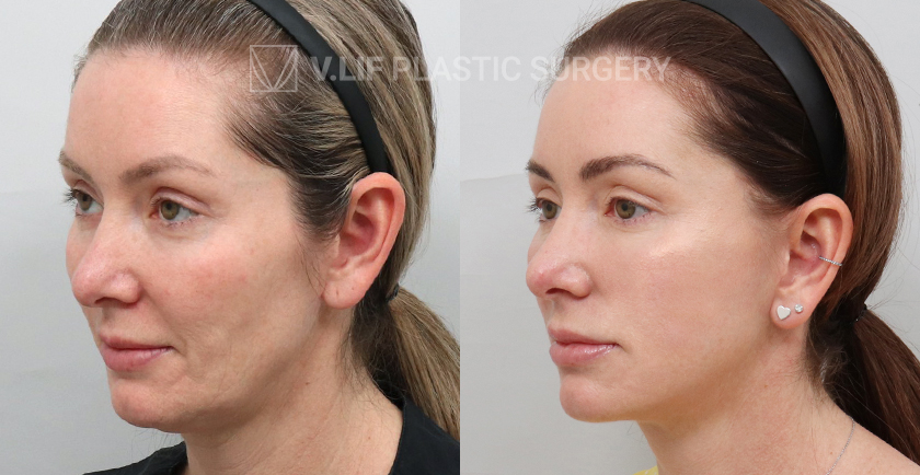 Face Neck Lift (Revision) before and after — Vlif Plastic surgery