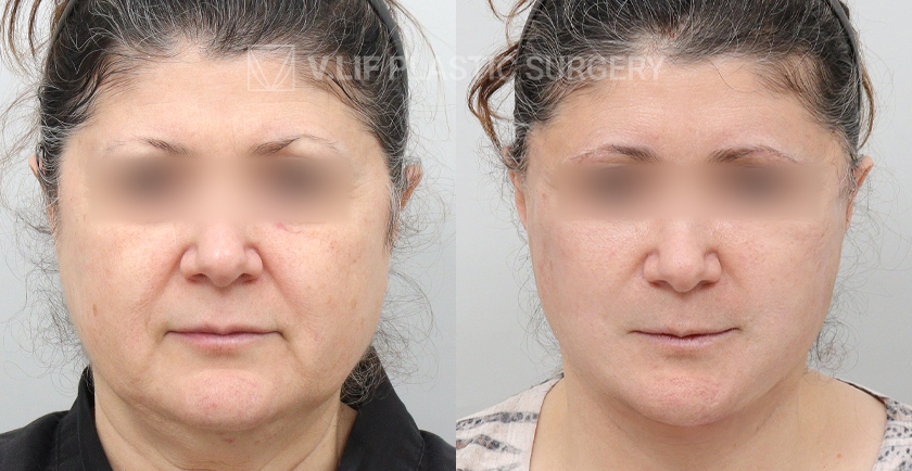 Face Neck Lift before and after — Vlif Plastic surgery