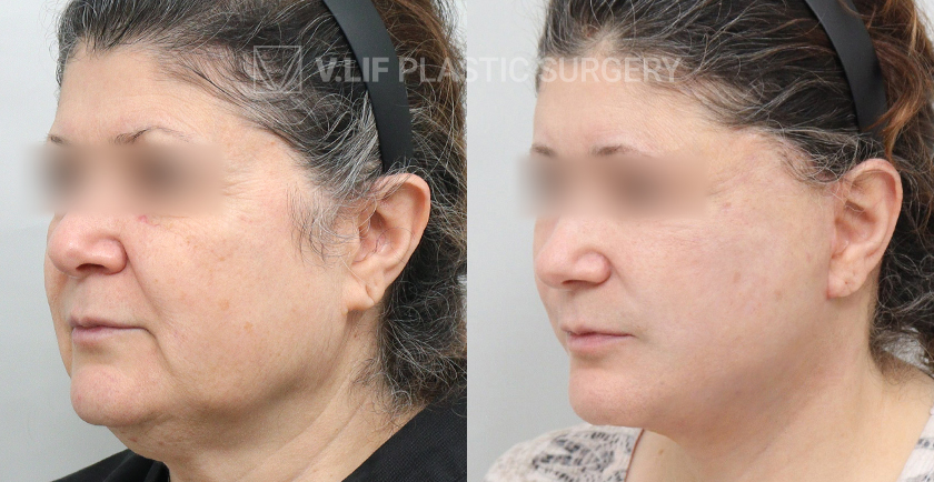 Face Neck Lift before and after — Vlif Plastic surgery