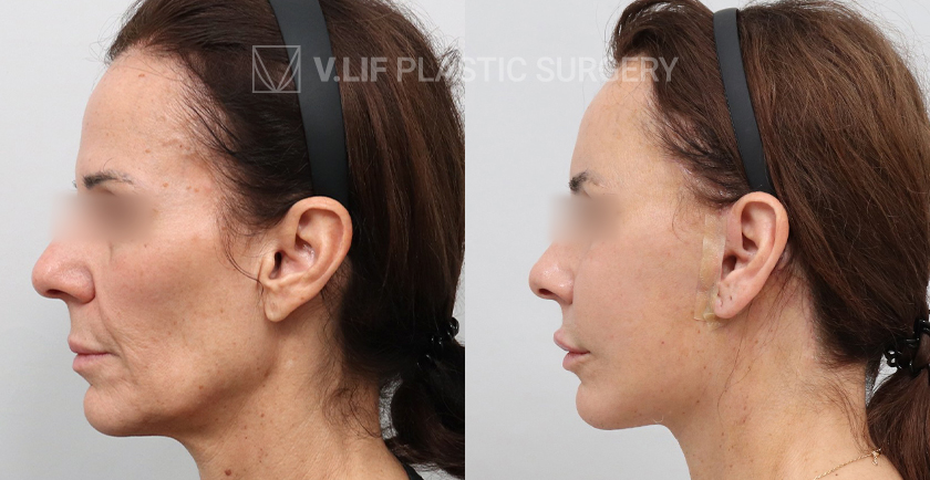 Face Neck Lift before and after — Vlif Plastic surgery