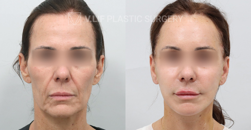 Face Neck Lift before and after — Vlif Plastic surgery