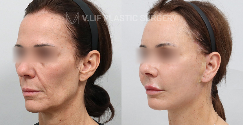 Face Neck Lift before and after — Vlif Plastic surgery