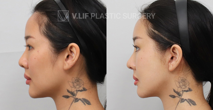 Facelift before and after — Vlif Plastic surgery