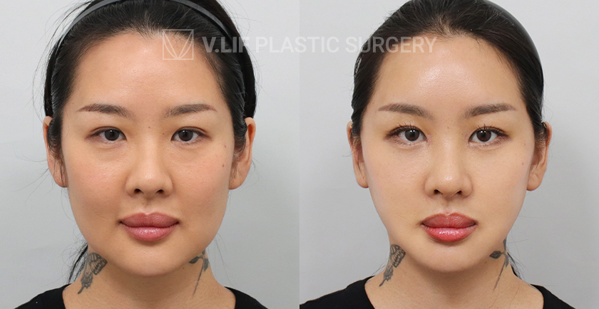 Facelift before and after — Vlif Plastic surgery