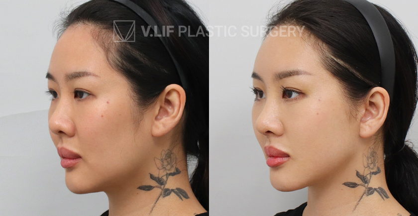 Facelift before and after — Vlif Plastic surgery