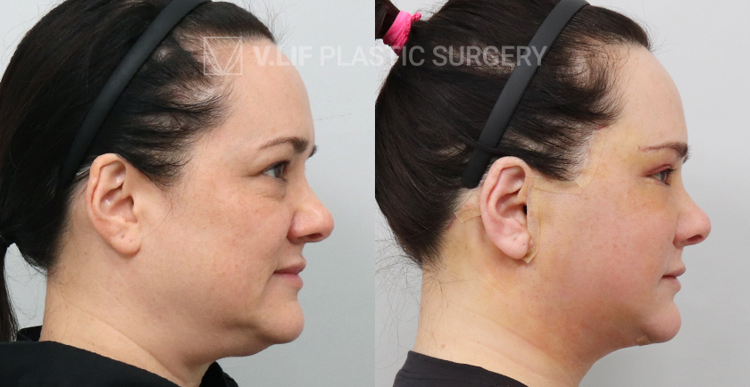 Face Neck Lift before and after — Vlif Plastic surgery