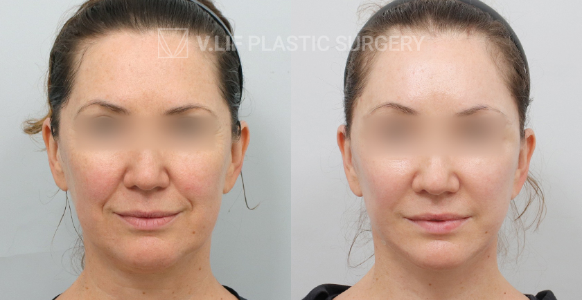 Face Neck Lift before and after — Vlif Plastic surgery
