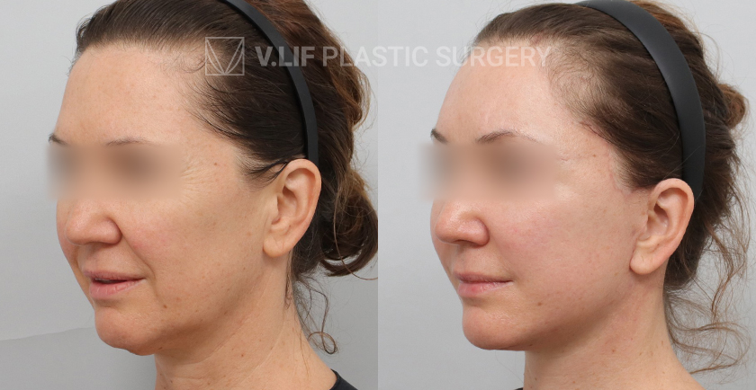 Face Neck Lift before and after — Vlif Plastic surgery