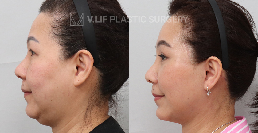 Face Neck Lift before and after — Vlif Plastic surgery