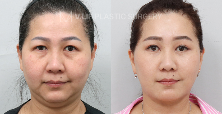Face Neck Lift before and after — Vlif Plastic surgery
