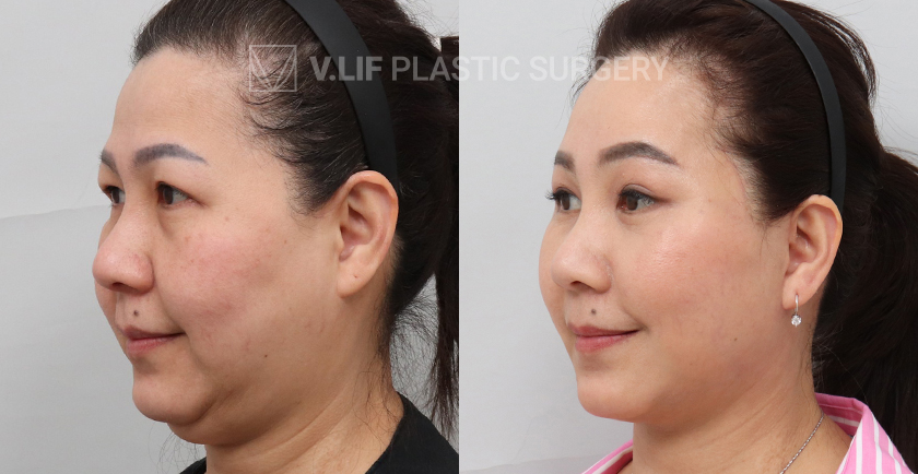 Face Neck Lift before and after — Vlif Plastic surgery