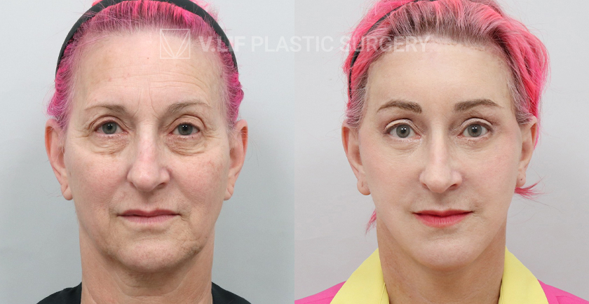 Face Neck Lift before and after — Vlif Plastic surgery