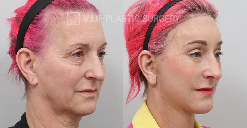 Face Neck Lift before and after — Vlif Plastic surgery