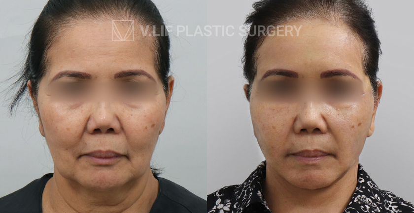Face Neck Lift before and after — Vlif Plastic surgery