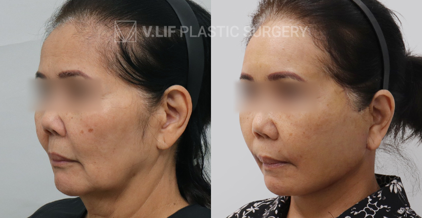 Face Neck Lift before and after — Vlif Plastic surgery
