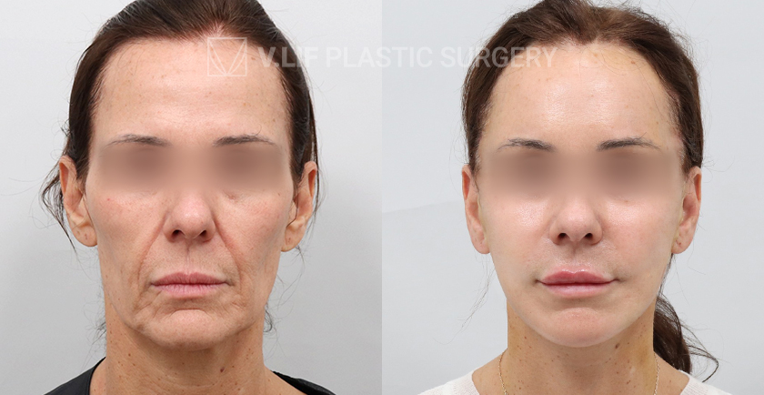Facelift Endoscopic Forehead Lift before and after — Vlif Plastic surgery