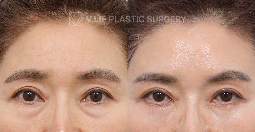 Lower Blepharoplasty before and after — Vlif Plastic surgery