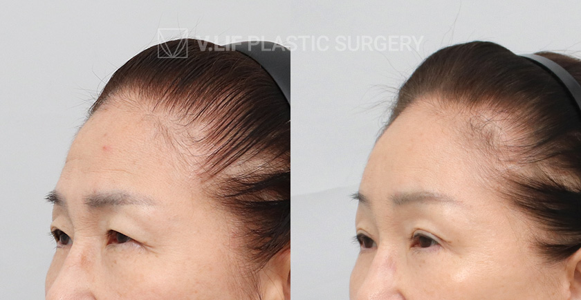 Endoscopic Forehead Lift Face Neck Lift Lower Blepharoplasty before and after — Vlif Plastic surgery