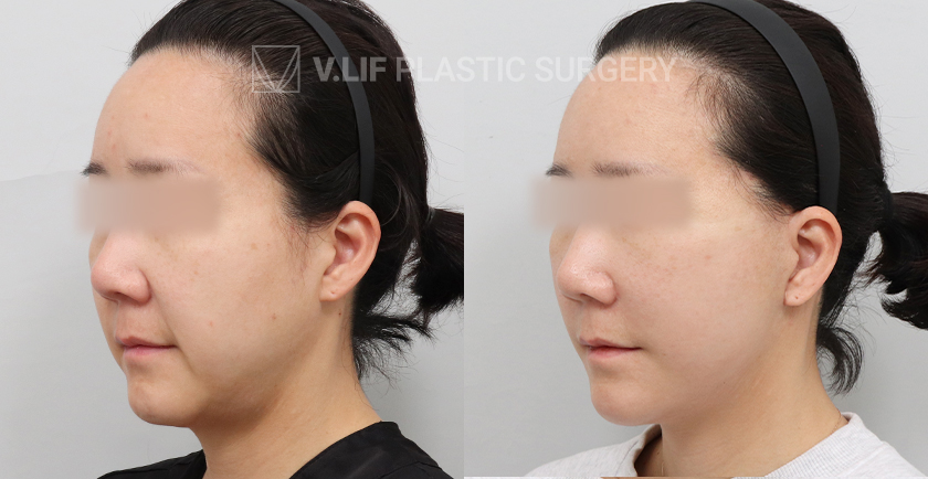 Facelift before and after — Vlif Plastic surgery
