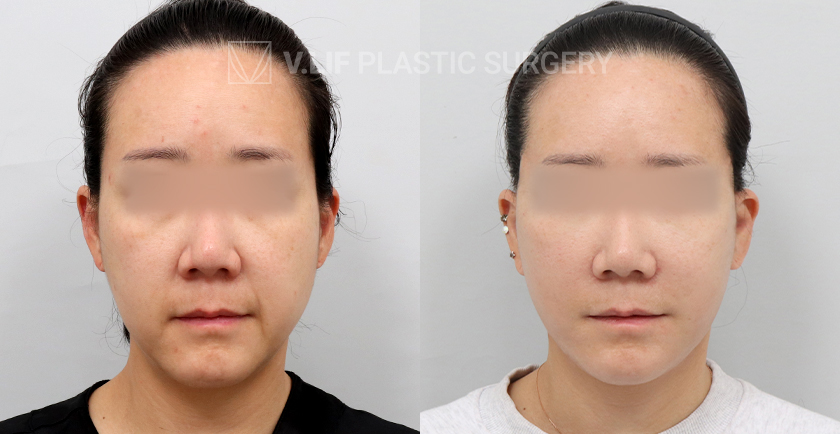 Facelift before and after — Vlif Plastic surgery