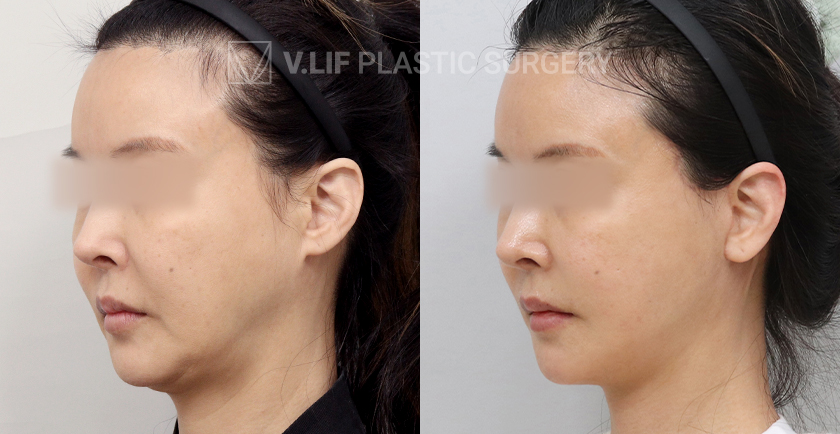 Facelift before and after — Vlif Plastic surgery