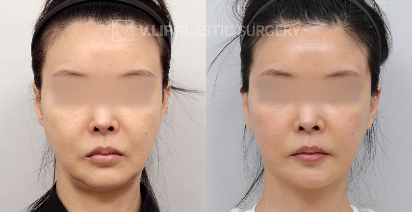 Facelift before and after — Vlif Plastic surgery
