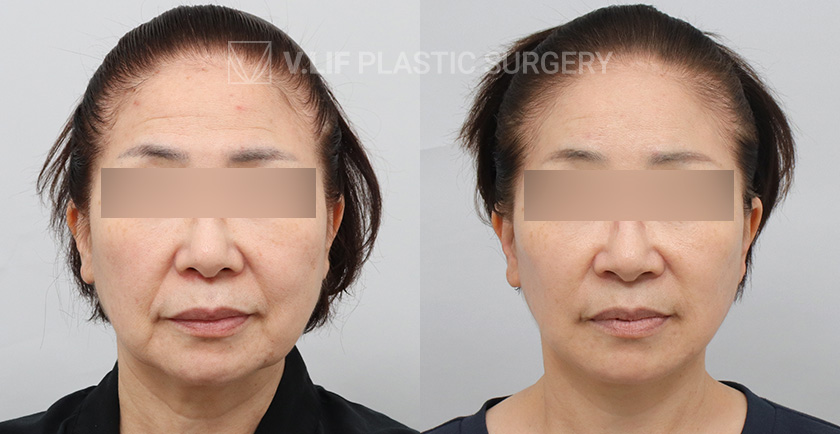 Face Neck Lift Endoscopic Forehead Lift Lower Blepharoplasty before and after — Vlif Plastic surgery