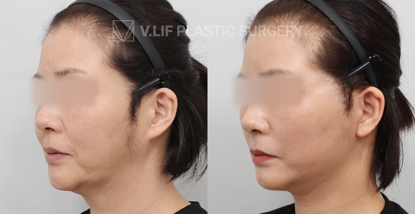 Facelift before and after — Vlif Plastic surgery