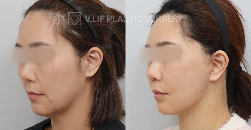 Facelift before and after — Vlif Plastic surgery
